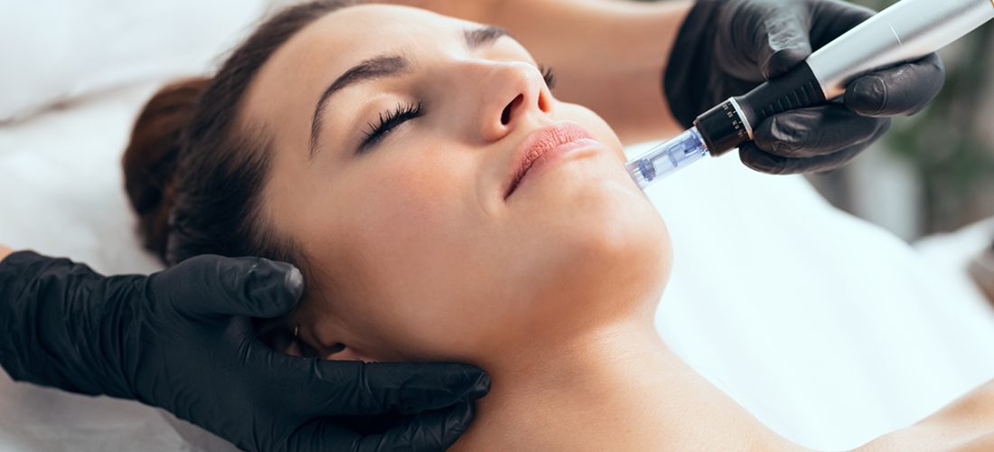 microneedling